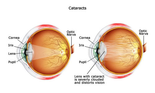 Cataracts img | Welch, Allan & Associates